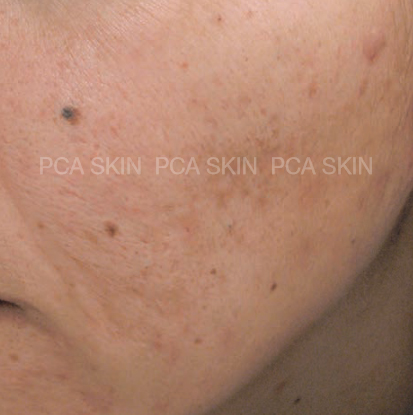 Chemical peels, New Image Works