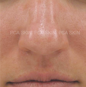 Chemical peels, New Image Works