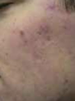 acne treatment with Fotona laser