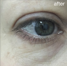 Acne scar reduction with Fotona laser Miami