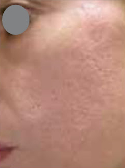 Acne scar reduction with Fotona laser Miami