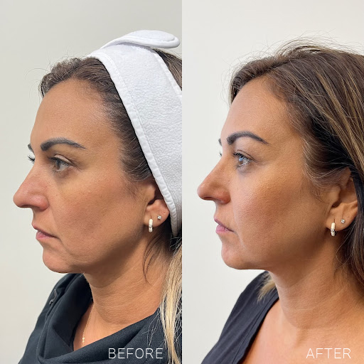 Sylfirm X Radiofrequency Microneedling new image works