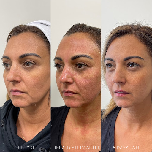 Sylfirm X Radiofrequency Microneedling new image works