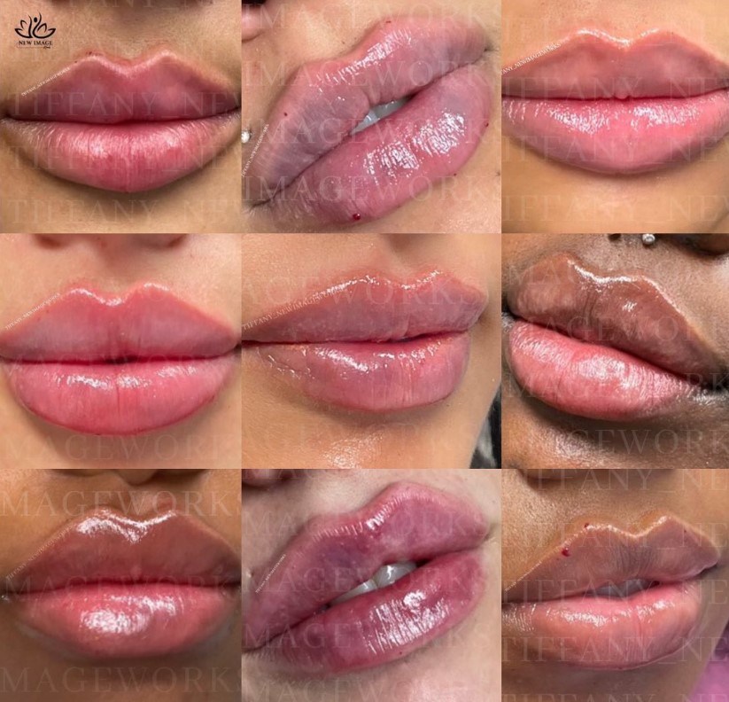 Wanted Lip Fillers - Russian lip technique