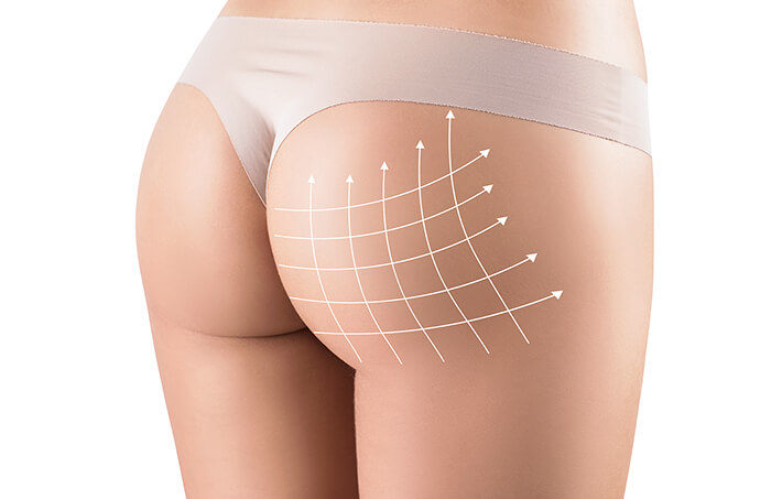 Buttock Enhancement Chicago - Butt Augmentation Chicago IL