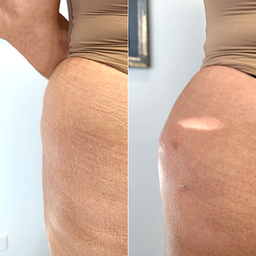 Achieving a Sculpted Silhouette: The Sculptra Butt Lift