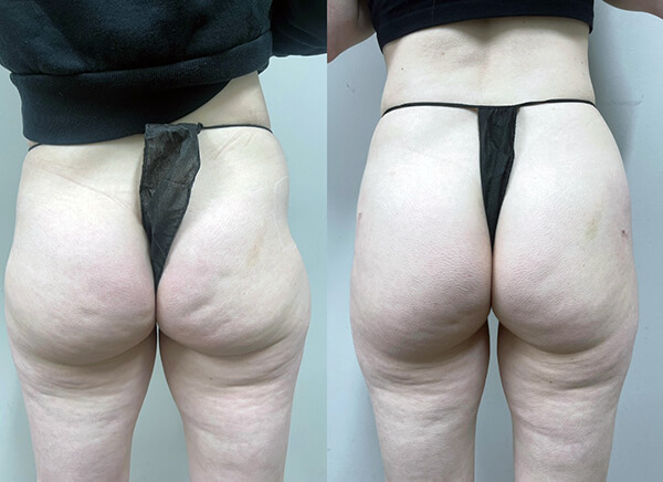 Achieving a Sculpted Silhouette: The Sculptra Butt Lift