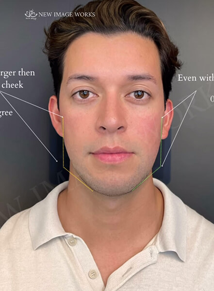 Male Face Enhancement with Dermal Fillers