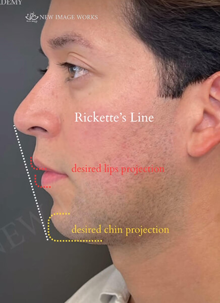 Male Face Enhancement with Dermal Fillers
