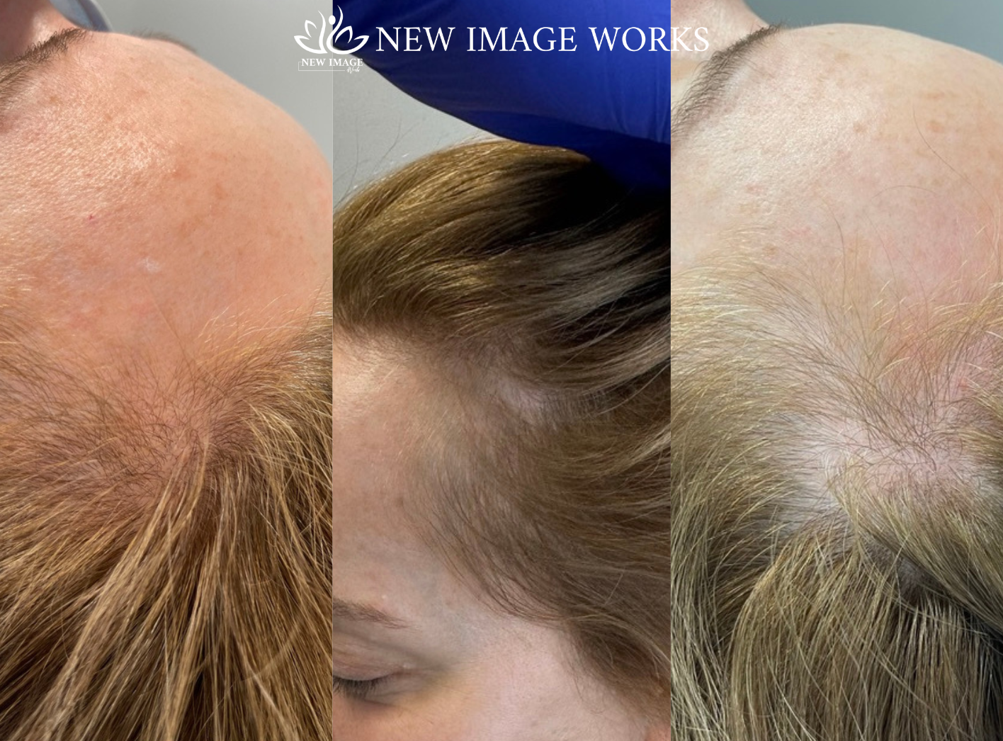 PRF treatments - New Image Works