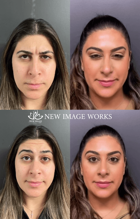 Botox New Image Works