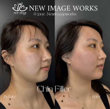 Chin Filler New Image Works