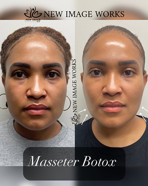 Masseter Botox