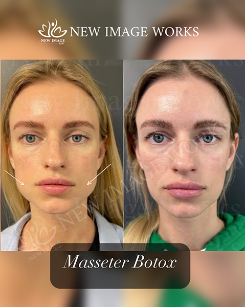 Masseter Botox