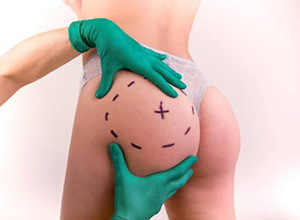 Sculptra Butt Lift