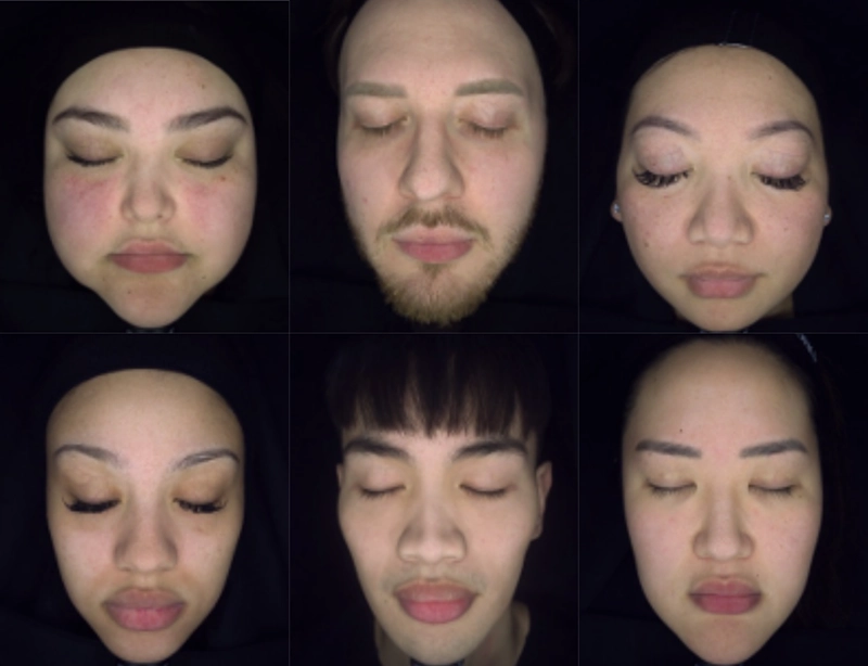 Vascular skin analysis showing redness and rosacea; Sciton BBL recommended to reduce redness and improve clarity.