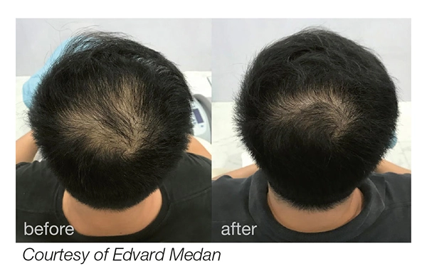 HAIRestart Treatment