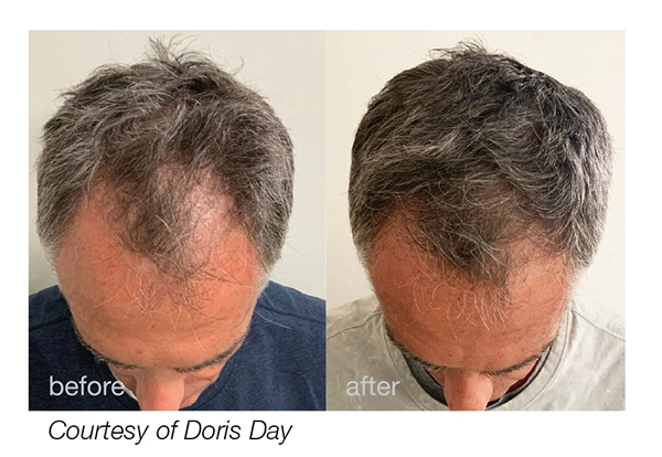 HAIRestart Treatment