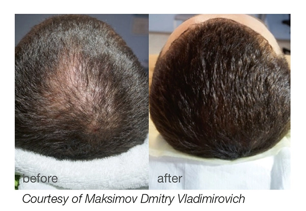 HAIRestart Treatment