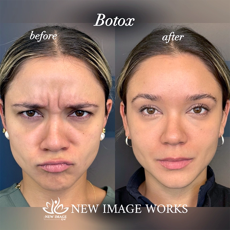BOTOX in Chicago