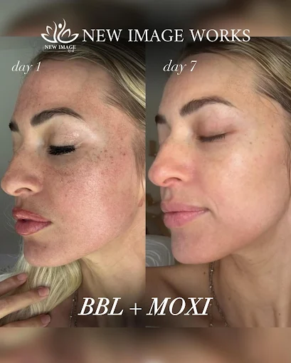 BBL and Moxi before and after results in Glenview