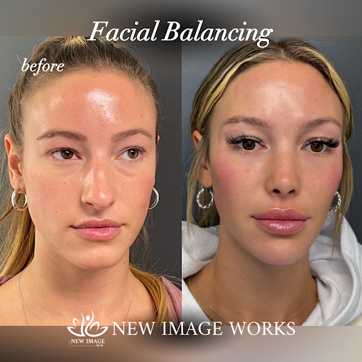 Facial balancing before and after results at New Image Works Glenview