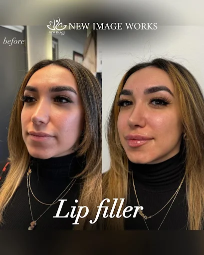Natural lip filler before and after in Glenview