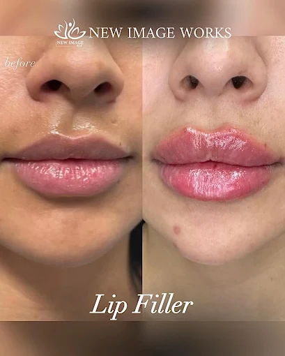 Lip filler before and after results at New Image Works Glenview